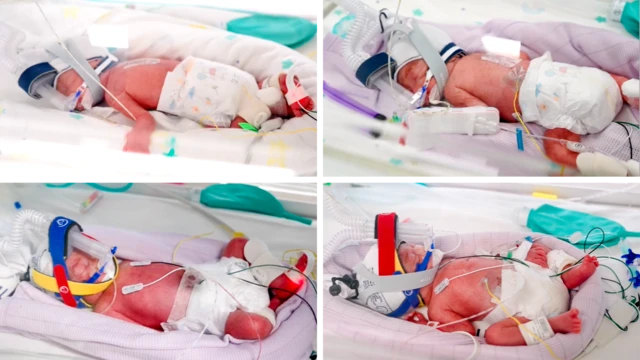 Fenómeno Médico en Australia: El Rarísimo Nacimiento Natural de Cuatrillizas Idénticas