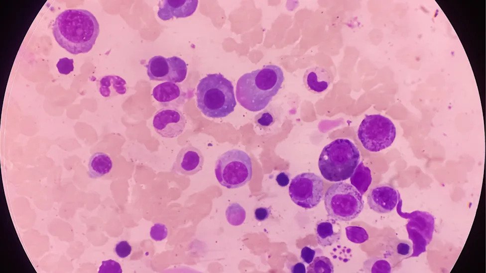 Mieloma Múltiple en México: Guías Actualizadas y Terapias Innovadoras Redefinen el Abordaje Clínico Mieloma Multiple en Mexico Guias Actualizadas y Terapias Innovadoras Redefinen el Abordaje Clinico