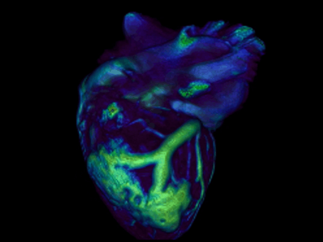 Microplásticos en Arterias Humanas: Una Amenaza Silente a la Salud Cardiovascular Global Microplasticos en Arterias Humanas Una Amenaza Silente a la Salud Cardiovascular Global