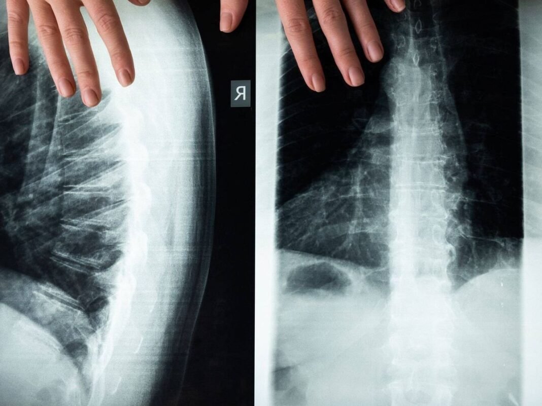 Rusia Anuncia Primer Trasplante de Medula Espinal Humana Un Hito Medico Bajo Escrutinio Global